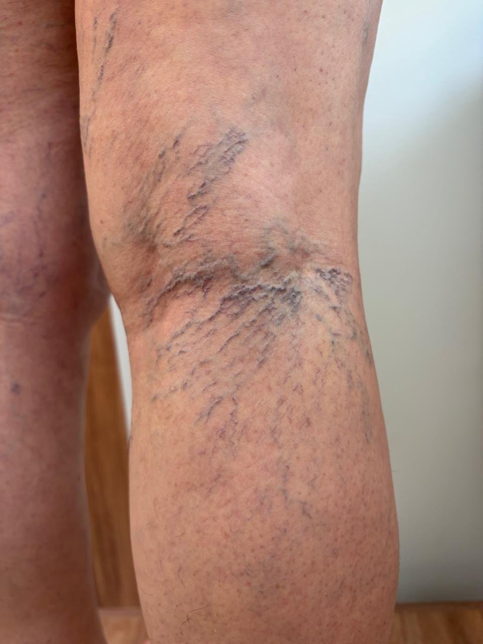 Vasinhos tratados com escleroterapia